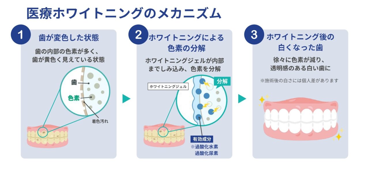 医療ホワイトニングのメカニズム